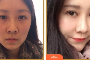 淮北愛爾眼科醫(yī)院魏林整形價(jià)格表附眼部綜合案例展示