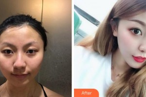 銅陵愛爾眼科醫(yī)院姜夏泉整形價(jià)格表附眼部整形案例展示