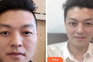 銅陵愛爾眼科醫(yī)院陶小林整形價(jià)格表附切開雙眼皮案例展示