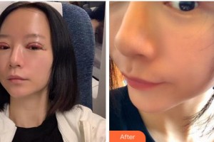 銅陵市立醫(yī)院眼科方劍峰整形價(jià)格表附切開雙眼皮案例展示