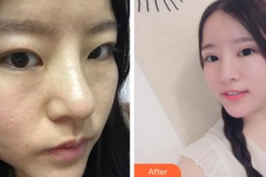 安慶亞星醫(yī)療美容門診部劉一正整形價(jià)格表附切開雙眼皮案例展示