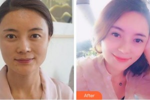 安慶市第一人民醫(yī)院整形外科程富順整形價(jià)格表附切開雙眼皮案例展示