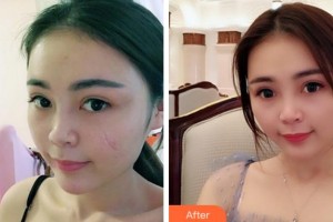 安慶石化醫(yī)院醫(yī)學(xué)美容中心丁應(yīng)忠整形價(jià)格表附注射祛疤案例展示