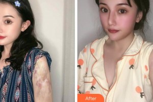 安慶石化醫(yī)院醫(yī)學(xué)美容中心楊賢金整形價(jià)格表附微創(chuàng)疤痕修復(fù)案例展示