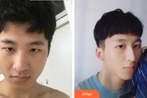 安慶現(xiàn)代婦產(chǎn)醫(yī)院整形美容中心林昌輝整形價(jià)格表附鼻部整形案例展示