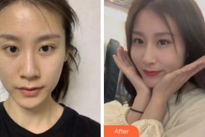 安慶市第二人民醫(yī)院眼科江兆源整形價(jià)格表附切開雙眼皮案例展示