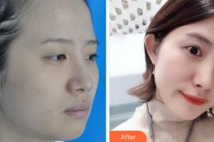 黃山市第三人民醫(yī)院眼科丁勝鵬整形價(jià)格表附眼部綜合案例展示