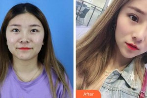 滁州伊爾美整形醫(yī)院孫洪香整形價(jià)格表附切開(kāi)雙眼皮案例展示