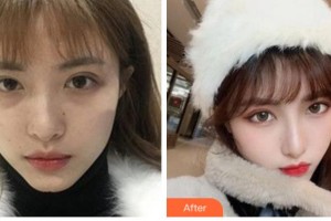 阜陽(yáng)市人民醫(yī)院整形美容外科盛華整形價(jià)格表附熱瑪吉案例展示