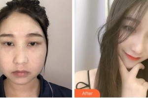 阜陽(yáng)市人民醫(yī)院整形美容外科方建強(qiáng)住院醫(yī)師整形價(jià)格表附埋線提升案例展示