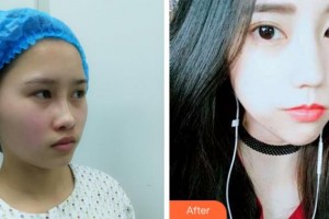 阜陽(yáng)皮膚病醫(yī)院醫(yī)療美容科王世明整形價(jià)格表附埋線提升案例展示