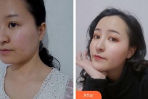 阜陽(yáng)皮膚病醫(yī)院醫(yī)療美容科王峰整形價(jià)格表附抗衰案例展示