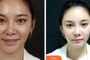 阜陽(yáng)東方美萊塢醫(yī)療美容醫(yī)院劉洪魁整形價(jià)格表附埋線提升案例展示