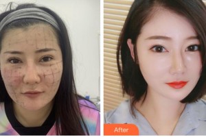 阜陽(yáng)東方美萊塢醫(yī)療美容醫(yī)院袁艷整形價(jià)格表附熱瑪吉案例展示