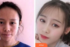 阜陽(yáng)楊鈞美容整形門(mén)診部楊利整形價(jià)格表附埋線提升案例展示