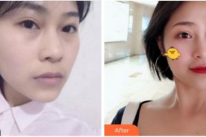 阜陽(yáng)七院愛(ài)爾眼科醫(yī)院尚力強(qiáng)整形價(jià)格表附面部抗衰案例展示