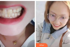 阜陽(yáng)愛(ài)齒口腔門(mén)診部陳立志整形價(jià)格表附全瓷牙案例展示