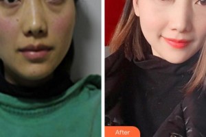 阜陽(yáng)七院愛(ài)爾眼科醫(yī)院姚艷芳整形價(jià)格表附激光去眼袋案例展示