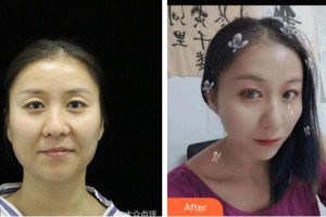 阜陽(yáng)七院愛(ài)爾眼科醫(yī)院馬頌章整形價(jià)格表附眼部修復(fù)案例展示