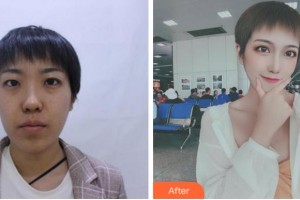 阜陽七院愛爾眼科醫(yī)院孫翠玲整形價格表附眼部綜合案例展示