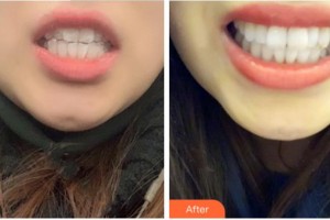 阜陽貝德口腔門診部張永康整形價格表附隱形托槽矯正案例展示