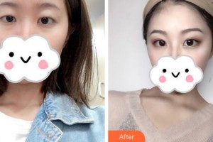 阜陽納美星范醫(yī)療美容門診部高陽整形價格表附切開雙眼皮案例展示