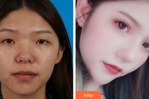 阜陽澤明眼科醫(yī)院張桂山整形價格表附切開雙眼皮案例展示