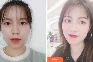 宿州陽光醫(yī)療美容醫(yī)院蔣相峰整形價格表附眼部整形案例展示