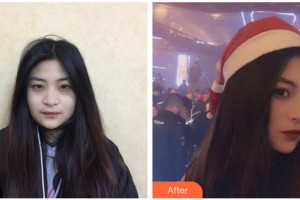 宿州韓仕醫(yī)療美容診所丁淑茹整形價格表附雙眼皮案例展示