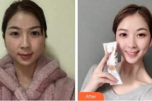 宿州天使醫(yī)療美容門診部谷曉紅整形價格表附激光祛斑案例展示