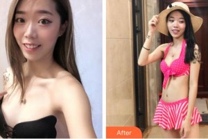 宿州康麗醫(yī)療美容門診部胡朝暉整形價格表附自體脂肪隆胸案例展示