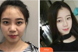 宿州漢密爾頓醫(yī)學(xué)美容醫(yī)院樸尚恩整形價格表附隆鼻案例展示