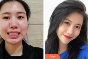 宿州愛牙口腔醫(yī)院張偉彬整形價格表附牙齒隱形矯正案例展示