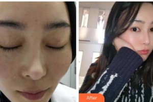 六安伊而美醫(yī)療整形美容醫(yī)院陳敬武整形價格表附激光祛斑案例展示