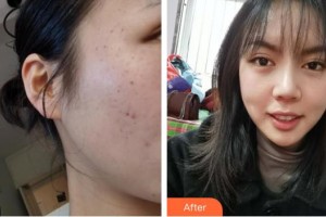 六安伊而美醫(yī)療整形美容醫(yī)院黃莉整形價格表附祛斑案例展示