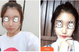 六安嘉秀醫(yī)療美容門診部翁上喬整形價格表附光子嫩膚案例展示