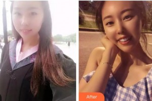 六安菲凡整形醫(yī)院程啟整形價(jià)格表附牙齒陶瓷矯正案例展示