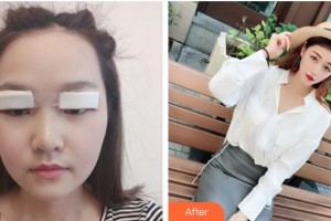 六安市第六人民醫(yī)院眼科佘傳應(yīng)整形價(jià)格表附眼部案例展示