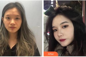 六安市中醫(yī)院眼科嚴(yán)靜整形價(jià)格表附眼部整形案例展示