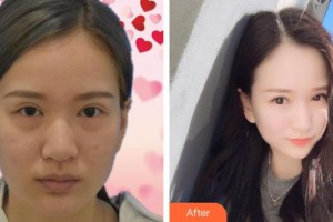 六安瑞視眼科醫(yī)院陳朝玉整形價(jià)格表附祛眼袋案例展示