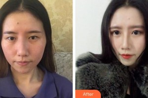 六安瑞視眼科醫(yī)院徐燕整形價(jià)格表附眼部手術(shù)案例展示