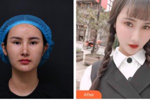 六安瑞視眼科醫(yī)院陳寶海整形價(jià)格表附眼部修復(fù)案例展示