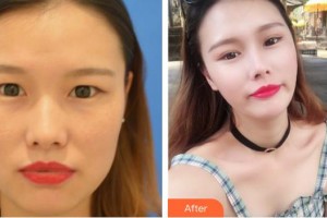 六安瑞視眼科醫(yī)院汪樂(lè)田整形價(jià)格表附雙眼皮案例展示