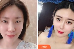 亳州締美醫(yī)療整形美容診所李為整形價(jià)格表附鼻部案例展示