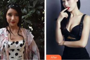 亳州華美整形美容醫(yī)院李劍整形價(jià)格表附隆胸案例展示