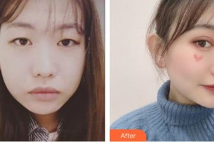 亳州締美醫(yī)療整形美容診所劉衛(wèi)整形價(jià)格表附眼部整形案例展示