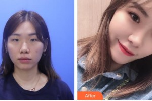 亳州愛(ài)爾眼科醫(yī)院楊智寬整形價(jià)格表附定點(diǎn)雙眼皮案例展示