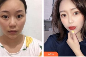 亳州市人民醫(yī)院整形外科薛仰杰整形價(jià)格表附眼部手術(shù)案例展示