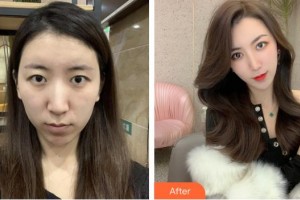 亳州愛(ài)爾眼科醫(yī)院褚彪整形價(jià)格表附眼部手術(shù)案例展示