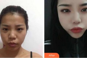 亳州雷賽眼科醫(yī)院楊德勝整形價(jià)格表附眼部案例展示